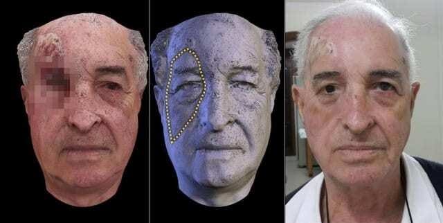 Prótese facial é criada a partir de um celular