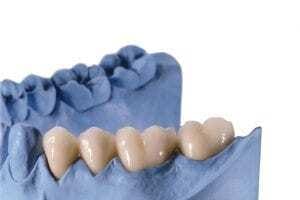 Molde feito na cor azul de boca de paciente com 4 dentes impressos em impressora 3D.