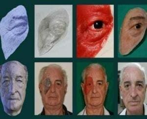 Brasil concebe uma prótese facial a partir de um celular 1
