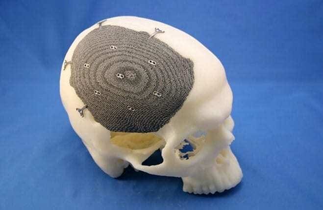 Impressão 3D de biomodelos salvando vidas humanas - Cranioplastia